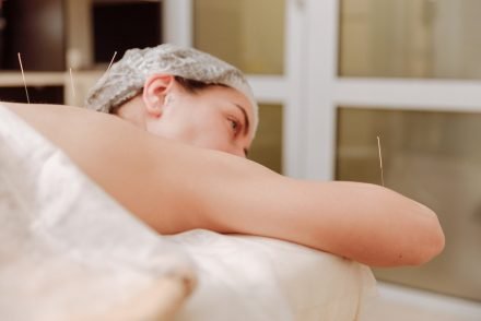 woman getting acupuncture
